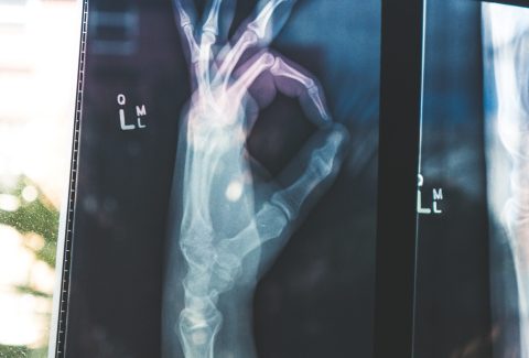 MI in Primary Care - Part 2